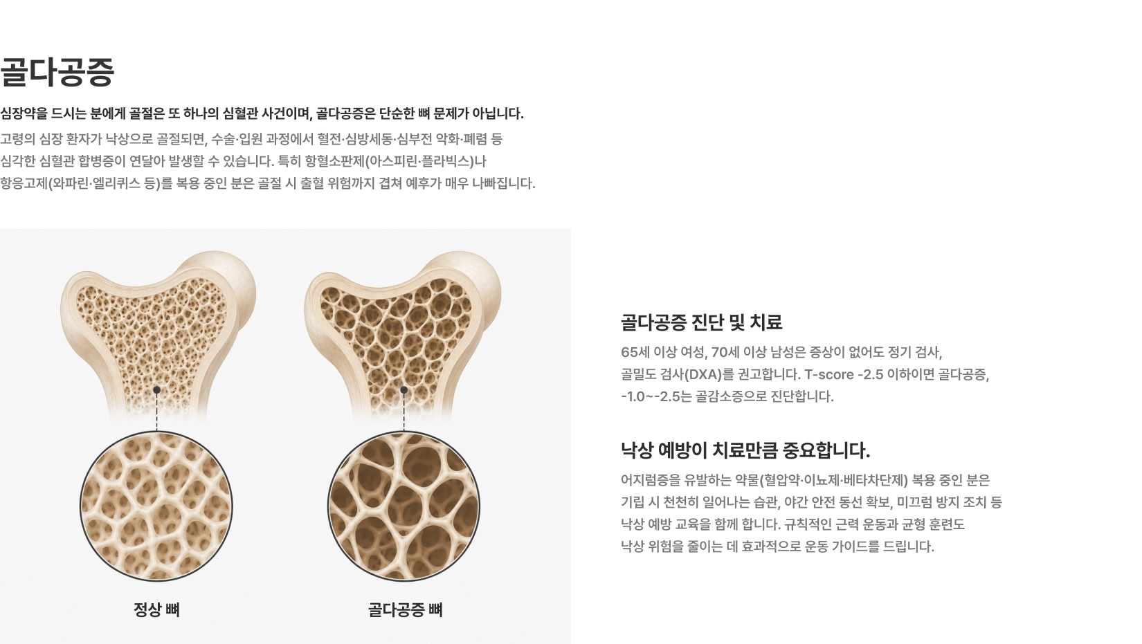 [골다공증] 심장약을 드시는 분에게 골절은 또 하나의 심혈관 사건이며 골다공증은 단순한 뼈 문제가 아닙니다 골다공증 진단 및 치료 낙상 예방