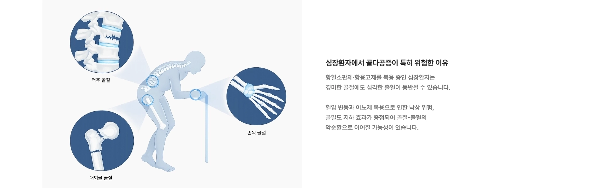[심장환자에서 골다공증이 특히 위험한 이유] 척추 골절 대퇴골 골절 손목 골절 항혈소판제·항응고제를 복용 중인 심장환자는 경미한 골절에도 심각한 출혈이 동반될 수 있습니다
