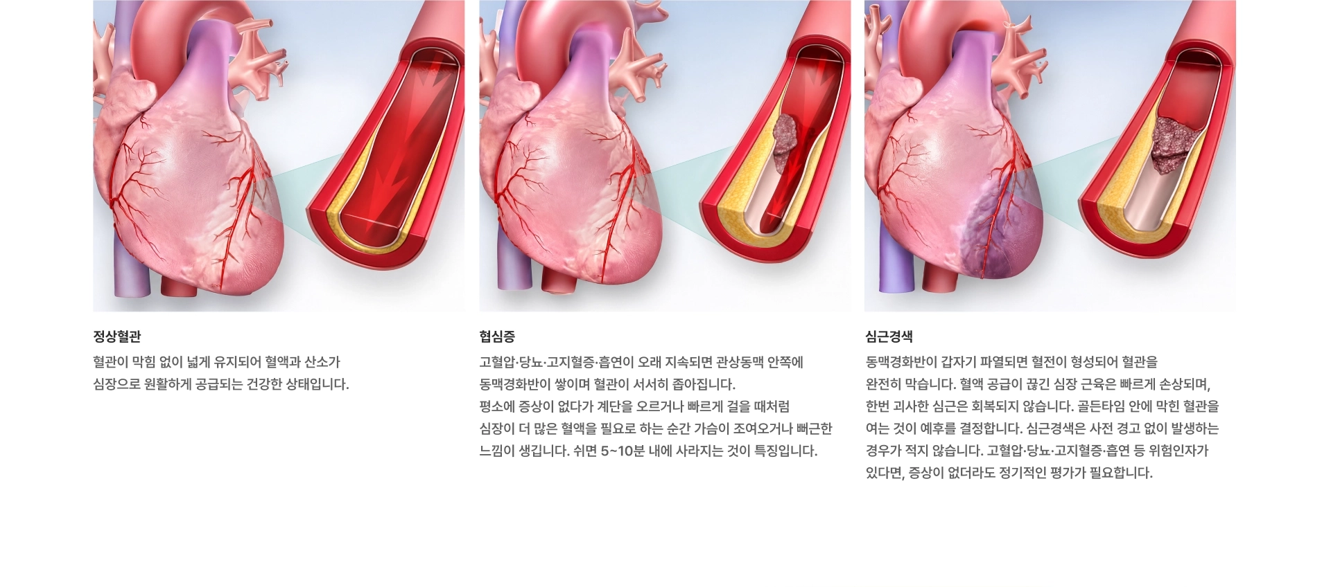 [협심증·심근경색] 심장도 혈액이 필요합니다 관상동맥이 좁아지거나 막히면, 협심증 또는 심근경색으로 이어집니다 정상혈관 협심증 심근경색