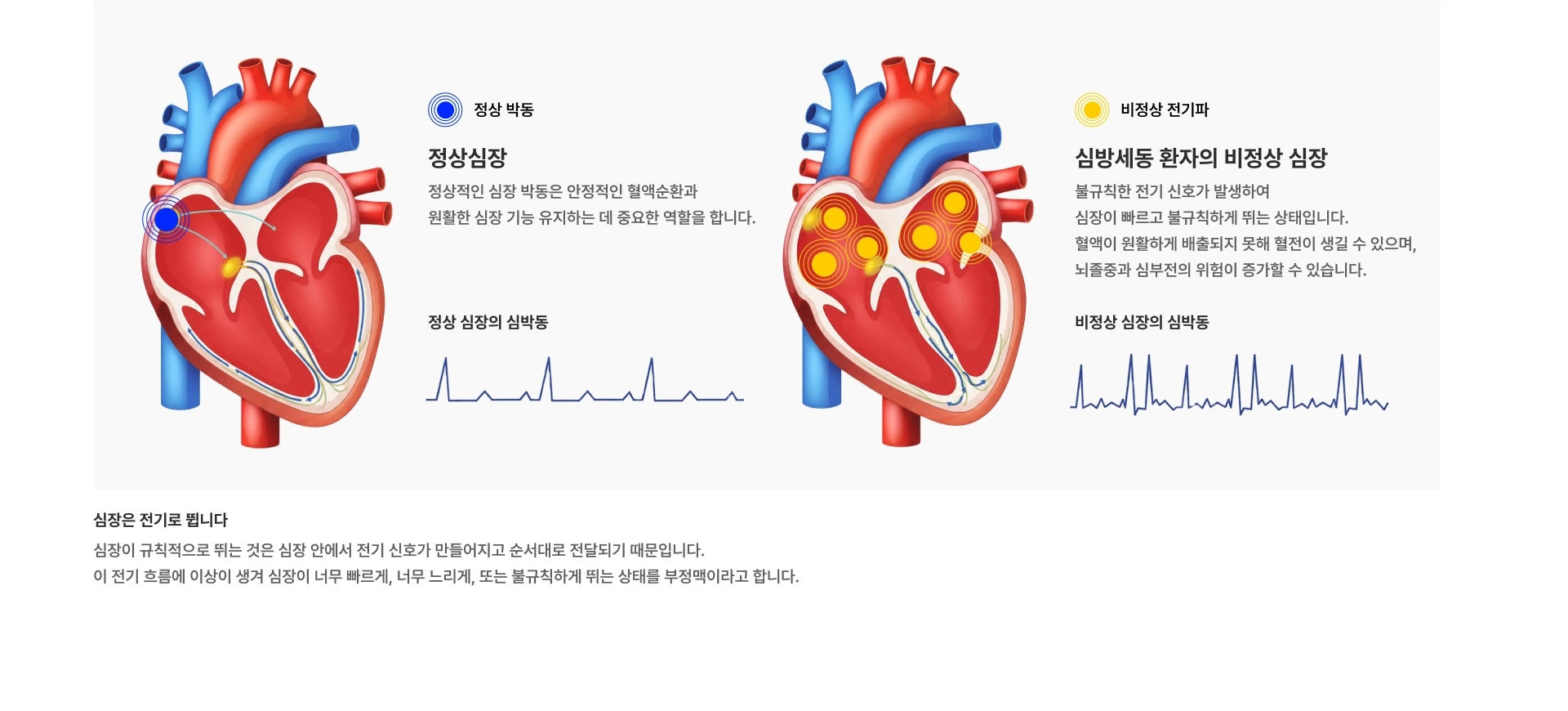 [정상심장] 정상 박동 정상 심장의 심박동 [심방세동 환자의 비정상 심장] 비정상 전기파 비정상 심장의 심박동 [심장은 전기로 뜁니다] 심장이 너무 빠르게, 너무 느리게, 또는 불규칙하게 뛰는 상태를 부정맥이라고 합니다