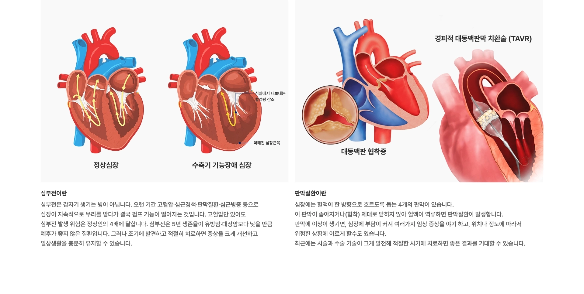 [심부전이란] 심부전은 갑자기 생기는 병이 아닙니다 오랜 기간 고혈압·심근경색·판막질환·심근병증 등으로 심장이 지속적으로 무리를 받다가 결국 펌프 기능이 떨어지는 것입니다 판막질환이란 심장에는 4개의 판막이 있습니다